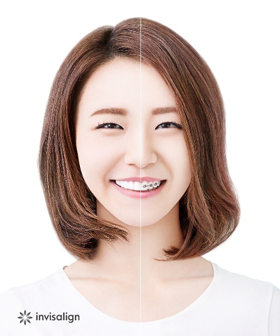 インビザライン矯正